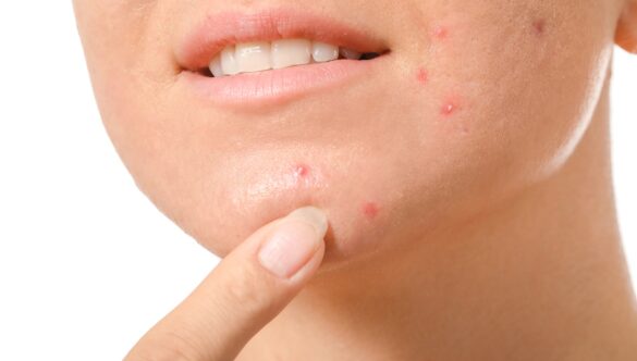 Il laser contro le cicatrici da acne
